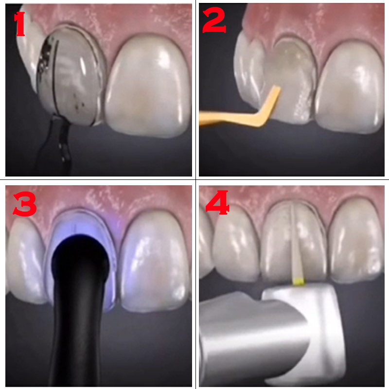 32개입 치아 미백 몰드 치과 실험실 키트 - 복합 레 - Teeth Whitening Moulds 리뷰 및 가격